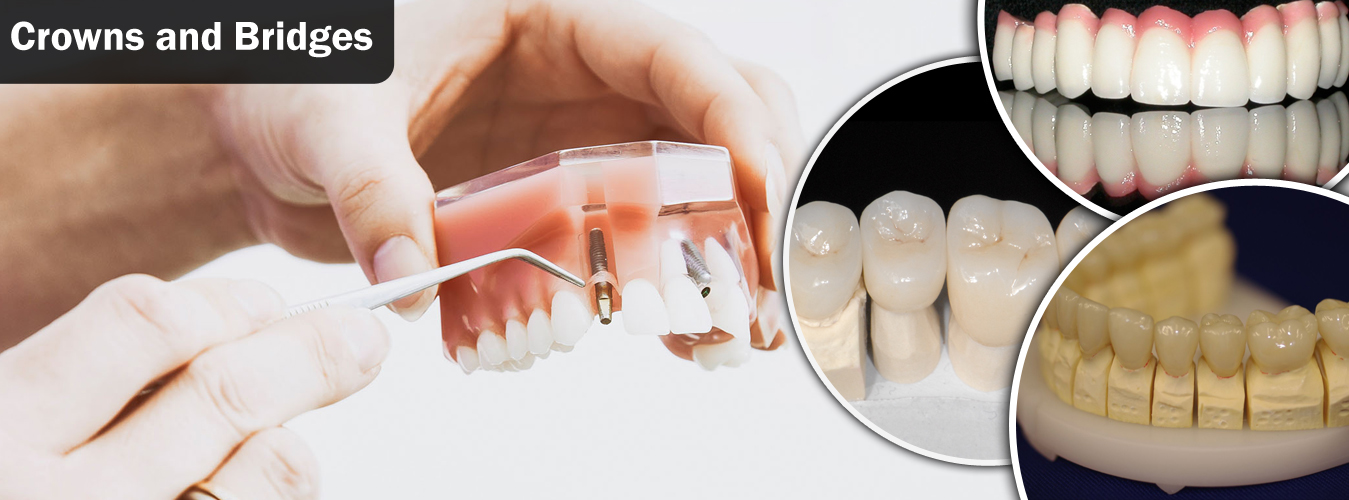 Best Dental Crowns and Bridge Fixing in Pune